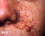 tuberous sclerosis