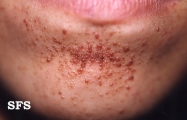 tuberous sclerosis