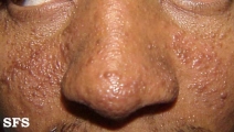 tuberous sclerosis