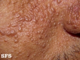 tuberous sclerosis