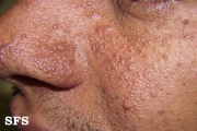 tuberous sclerosis