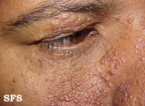 tuberous sclerosis