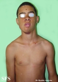 tuberous sclerosis