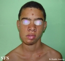 tuberous sclerosis
