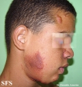 tuberous sclerosis