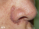 tuberous sclerosis