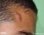 tuberous sclerosis