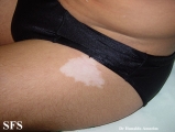 tuberous sclerosis