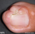 tuberous sclerosis