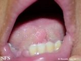 tuberous sclerosis