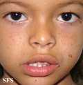 tuberous sclerosis
