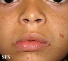 tuberous sclerosis