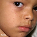 tuberous sclerosis