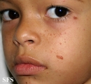 tuberous sclerosis