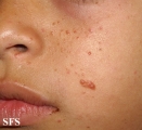tuberous sclerosis
