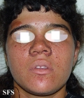 tuberous sclerosis