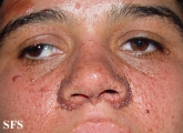 tuberous sclerosis