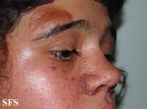 tuberous sclerosis