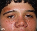 tuberous sclerosis