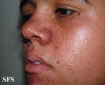 tuberous sclerosis