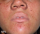 tuberous sclerosis