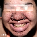 tuberous sclerosis