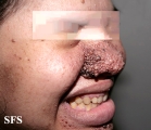 tuberous sclerosis