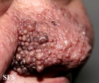 tuberous sclerosis