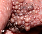 tuberous sclerosis