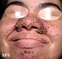 tuberous sclerosis
