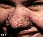 tuberous sclerosis