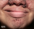 tuberous sclerosis
