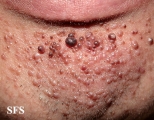 tuberous sclerosis