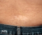 tuberous sclerosis