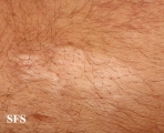 tuberous sclerosis