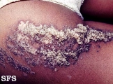 verrucous epidermal naevi