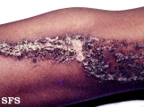 verrucous epidermal naevi