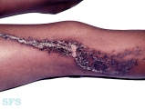 verrucous epidermal naevi
