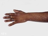 verrucous epidermal naevi