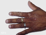 verrucous epidermal naevi