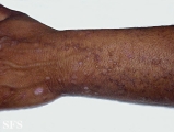 verrucous epidermal naevi