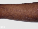 verrucous epidermal naevi