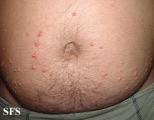 xanthoma eruptive