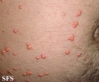 xanthoma eruptive