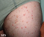 xanthoma eruptive