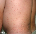 xanthoma eruptive