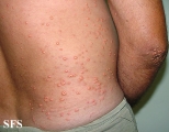 xanthoma eruptive