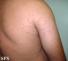 xanthoma eruptive