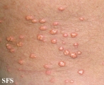 xanthoma eruptive