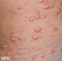 xanthoma eruptive
